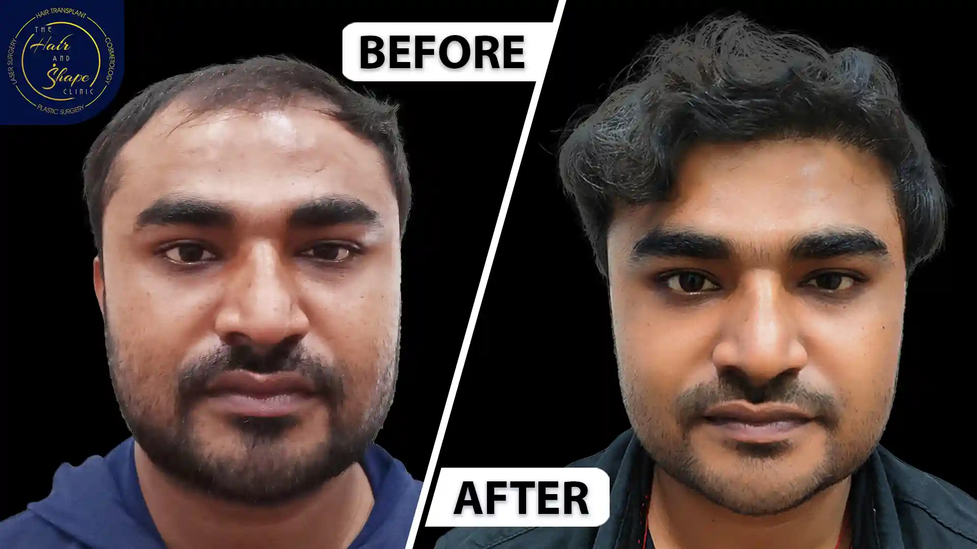 Hair Transplant result6